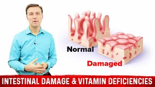 Intestinal Obstruction amp Vitamin Deficiencies – Dr Berg [upl. by Anert]