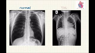 Tetralogy of fallot xray explanation l med by Abrar شرح بالعربي [upl. by Airpac]