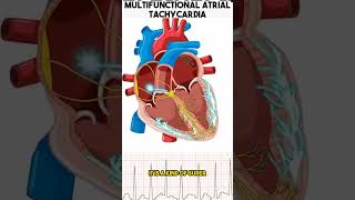 Heart related problems  Multifocal Atrial Tachycardia anatomy heartproblems shorts [upl. by Vikky]