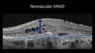 Course in clinical applications of OCT for macular diseases  Neovascular ARMD [upl. by Ennaehr]