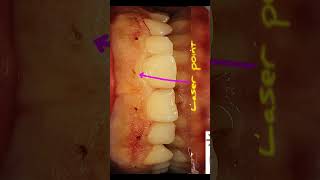 Laser gingivectomy [upl. by Dier]