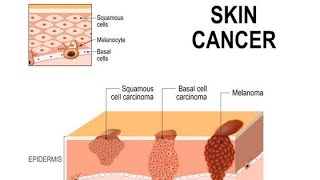 Basal Cell Carcinoma amp Squamous Cell Carcinoma  MSK Module cancer [upl. by Nauqyt888]