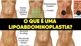 O QUE É UMA LIPOABDOMINOPLASTIA [upl. by Pierson]