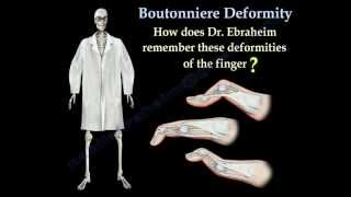 Boutonniere Deformity  Everything You Need To Know  Dr Nabil Ebraheim [upl. by Marlyn75]