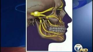 Trigeminal Neuralgia [upl. by Aratahc]