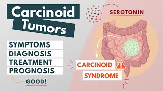 Carcinoid Tumor  Visual Explanation  Symptoms diagnosis treatment prognosis [upl. by Anerres]