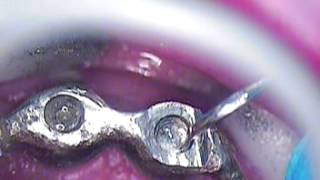 2 Dental Implant Broken Screw  Straumann occlusal screw replaced avoiding surgical options [upl. by Yrebmik]