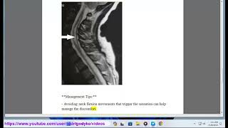 lhermitte sign 101 lhermittes sign differential diagnosis [upl. by Dorsey526]