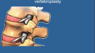 Vertebroplasty [upl. by Erroll]