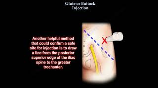 Glute injection buttock injection [upl. by Daht786]