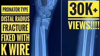 Manipulation Technique and Kwire of Pronator Type Distal Radius Fracture [upl. by Aikemal]