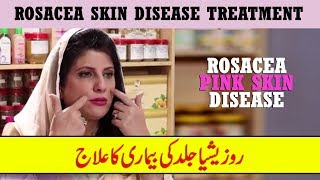 Rosacea Skin Disease Treatment by Dr Bilquis Shaikh  Rosacea Gulabi Skin Disease [upl. by Halbert]