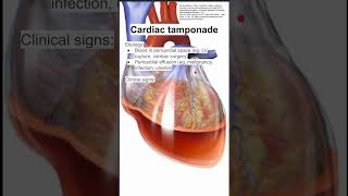 Cardiac tamponade [upl. by Littell796]