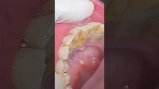 Scaling of calculus dentist calculus tartar dentalcalculu [upl. by Buyers]