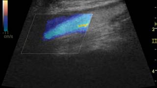 Vascular Ultrasound [upl. by Even]