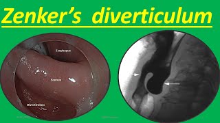 Zenkers diverticulum Symptoms Causes Diagnosis Treatment Complications and How it Occur [upl. by Akram]