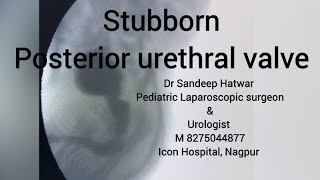 Posterior urethral valve fulguration [upl. by Hamaso]