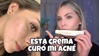 CREMA CURÓ MI ACNÉ acnoic gel peroxido de benzoilo y adapaleno [upl. by Havens49]