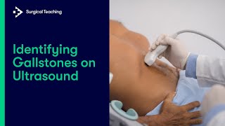 Learn How to Spot Gallstones on Ultrasound [upl. by Atcele643]