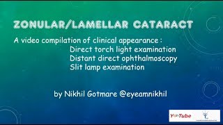 ZonularLamellar Cataract [upl. by Aronid]