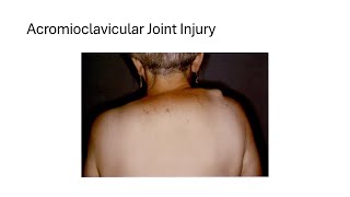 Acromioclavicular Joint Injury [upl. by Prisca673]