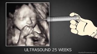 3rd Trimester Abortion [upl. by Cairns]