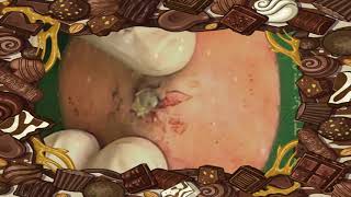 BEST Pimple Popping💖💖 blackheads2023 bestpimplepopping [upl. by Reiniar]