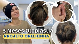 OTOPLASTIA COM PROJETO ORELHINHA CONTEI TUDO [upl. by Koorb514]