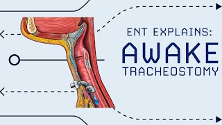 Awake Tracheostomy Explained Emergency Airway in OR [upl. by Nadnerb]