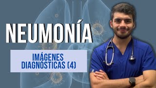 NEUMONÍA  Imágenes diagnósticas Parte 4 [upl. by Gustav]