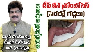 Deep Vein Thrombosis DVT  Prof Dr Murali Manohar Chirumamilla MD Ayurveda  సిరల్లో గడ్డలు [upl. by Nosirrah]