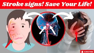 The most common Early Warning Signs Of A Stroke that people ignore and how to act fast [upl. by Jempty]