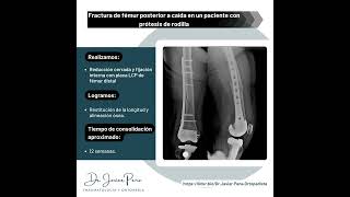 Fractura de fémur en paciente con prótesis total de rodilla  Dr Javier Peña Chávez [upl. by Ajnotal]