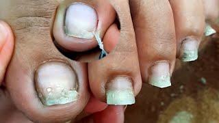 Satisfying Ingrown Toenail Removal  Dry Skin  Pedicure 116 [upl. by Idisahc557]