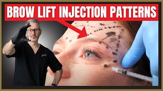 Botox Brow Lift Injection Patterns Botox MarkUp Tutorial [upl. by Ishii]