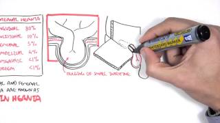 Introduction to Direct and Indirect Inguinal Hernia [upl. by Eanar]