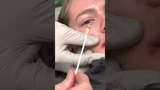 Draining of abscess from side of mouth [upl. by Arnelle]