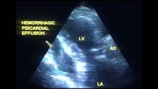 Pericardial effusion or hemopericardium to drahmadmirdamadisi4YcoVxIYKdkLrw2q [upl. by Sproul167]