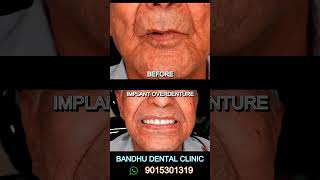 Implant Overdenture  very comfortable [upl. by Iramat]