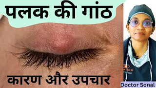 पलक मे गांठ  लक्षण कारण इलाज Home Remedies Chalazion Eyelid Cyst Doctor Sonal [upl. by Otrebire323]