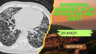 UIP Pattern  Differentials  HRCT Chest ild doctor medicalstudent neet mbbs [upl. by Ilat272]