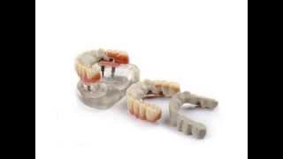 Dentures and all on four dental implant dentures made from JUVORA PEEK Dental Disc using CADCAM [upl. by Ollopa]