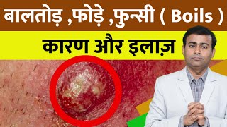 बालतोड़ फोड़े फुन्सी  Boils  कारण और इलाज़ boils How to Treat Boil At Home [upl. by Khan]