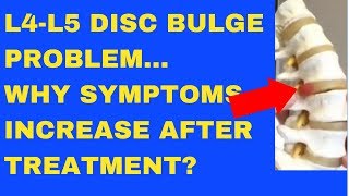 Why Does L4 L5 Disc Bulge Symptom Increase After Treatment  Answered by Chiropractor in Vaughan [upl. by Eyahs]