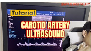 Carotid ultrasound  tutorial  doppler ultrasound DUS [upl. by Eninnej]