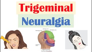 Trigeminal Neuralgia “Severe Facial Pain” Causes Pathophysiology Symptoms Diagnosis Treatment [upl. by Ware]