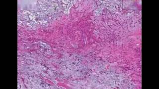 Histopathology Salivary glandPleomorphic adenoma mixed tu [upl. by Ecydnarb43]