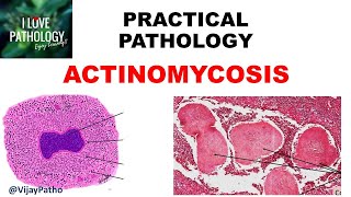 Practical Pathology ACTINOMYCOSIS [upl. by Gloria]