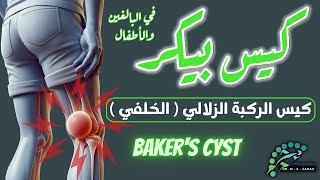 كيس بيكر  كيس quotخلف الركبةquot الزلالي  في البالغين والأطفال  Bakers Cyst Popliteal Cyst [upl. by Francyne957]