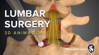 Lumbar Surgery  Laminectomy  3D Medical Animation [upl. by Olraced]